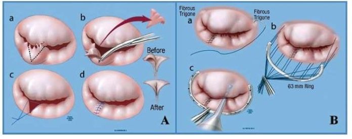 Mitral Kalp Kapakçığı Tedavisi