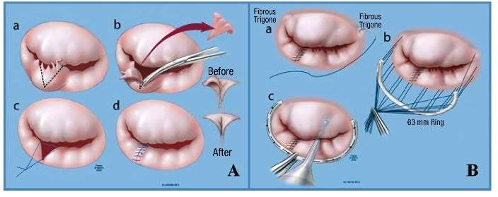 Mitral Kalp Kapakçığı Tedavisi Mitral Kalp Kapakçığı Tedavisi