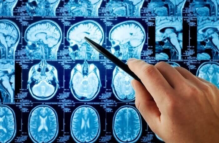 beyin röntgeni